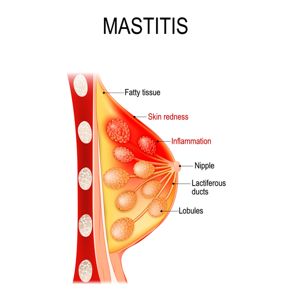 Mastitis. Cross-section of the mammary gland showing a breast tissue exhibiting mastitis symptoms, highlighting skin redness and inflammation among fatty tissue, laciferous ducts, and lobules (milk sacs)